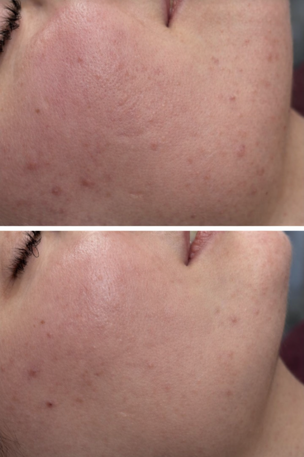 Efekty terapii trądziku - efekt 2