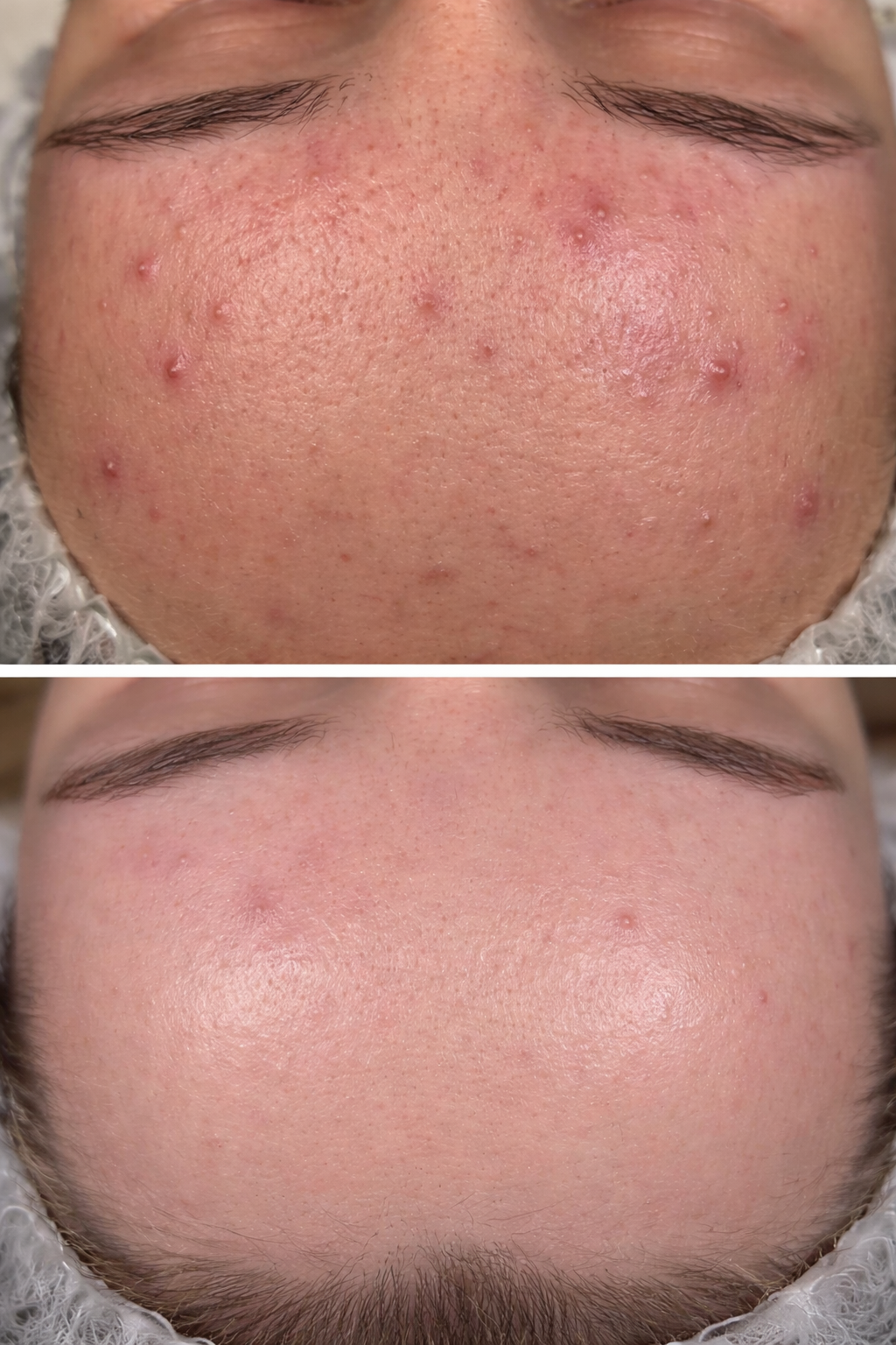 Efekty terapii trądziku - efekt 3