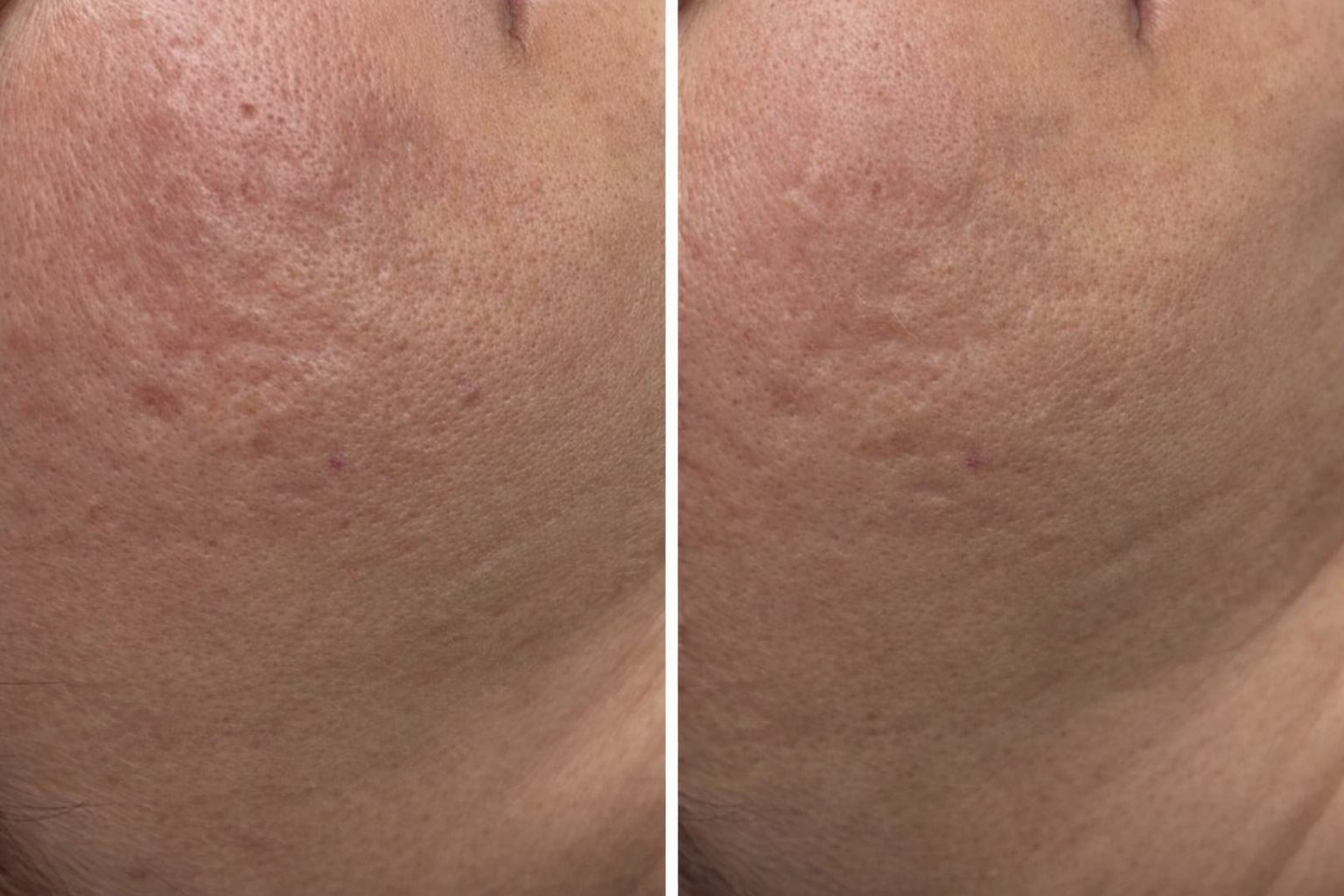 Usuwanie blizn - efekty